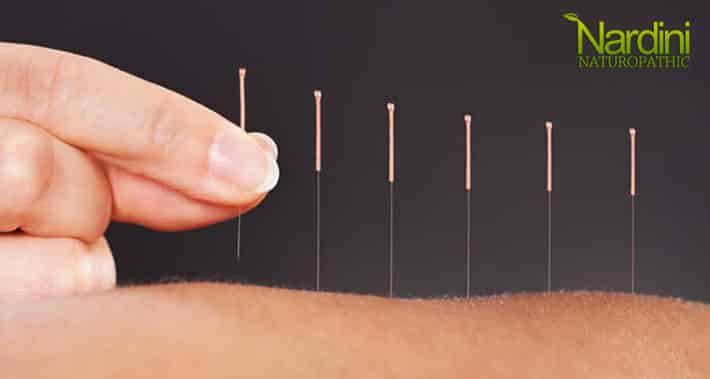 acupuncture as a way to help improve your immune system health | Nardini Naturopathic | Toronto Naturopath Clinic